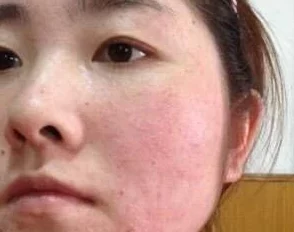 一面膜胸口一面膜下60分钟,女子惊现皮肤过敏,医生紧急介入引发关注! 一面膜胸口一面膜下60分钟,女子惊现皮肤过敏,医生紧急介入引发关注!